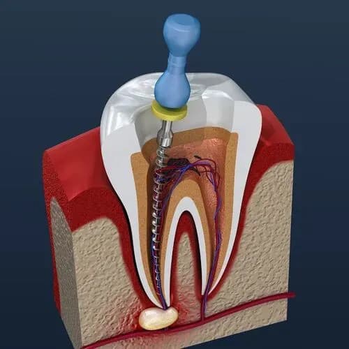 Get Root Canal Treatment at King