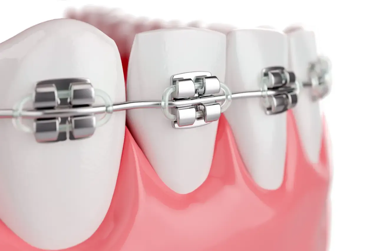 close-up-beauty-health-teeth-with-brace-selective-focus-3d-render (1)
