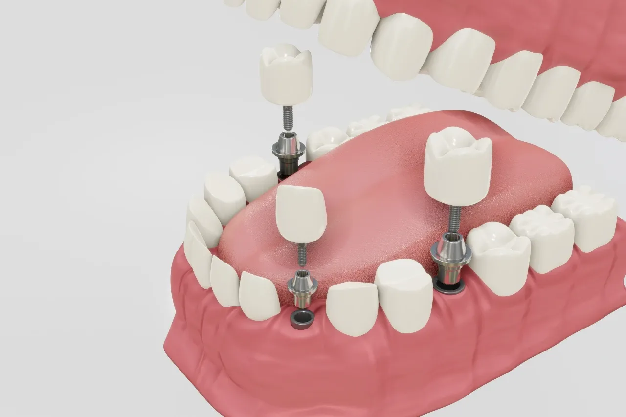 dental-implant