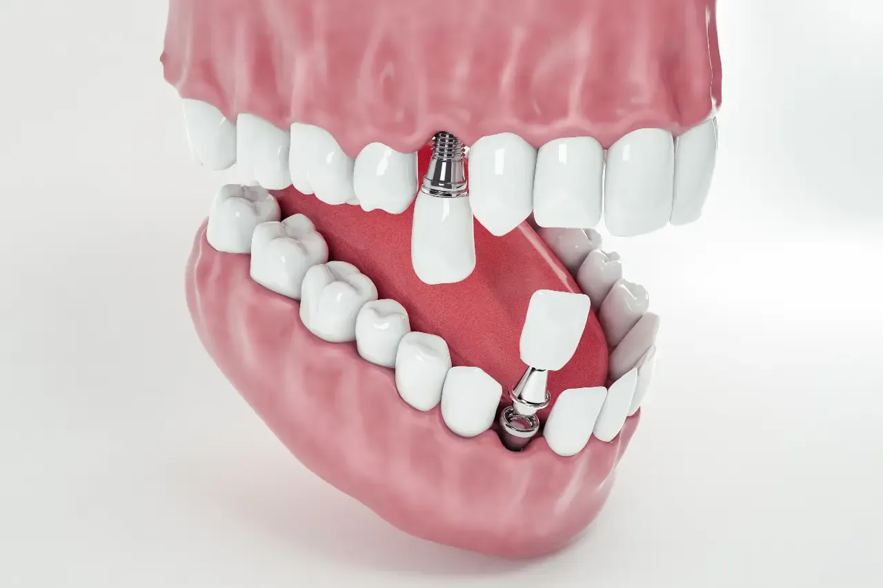 view-from-false-tooth-implant-fixed-jawbone-3d-3d-illustration (4)