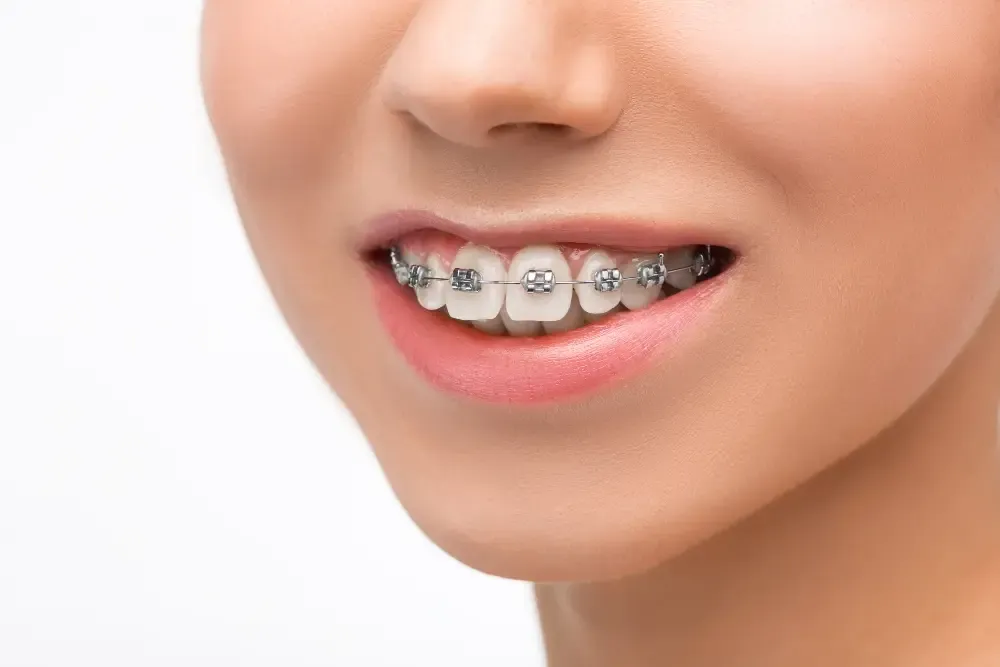 how-much-do-braces-hurt-on-a-scale-1--10