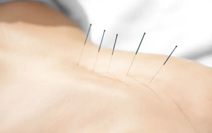 akupunktur nedir